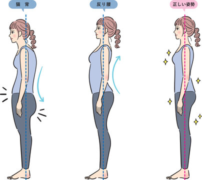 一見良い姿勢に見える反り腰と良い姿勢の比較イラスト