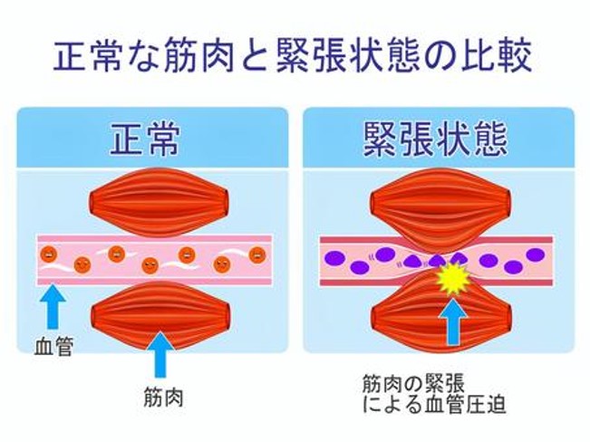正常な筋肉と緊張状態の筋肉、血流の違いイラスト